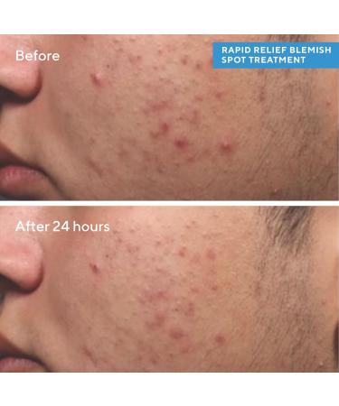 Murad Rapid Relief Spot Treatment 15ml - Buy Online on GoSupps.com