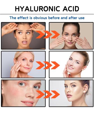 Hyaluronic Acid Microneedling Serum - Hyaluronic Acid Face Serum - Gla-Mory Micro-Infusion Facial System - Hyaluronic Acid Serum for Face - Dark Spot Remover for Face - Face Serum for Women - Buy Online on GoSupps.com