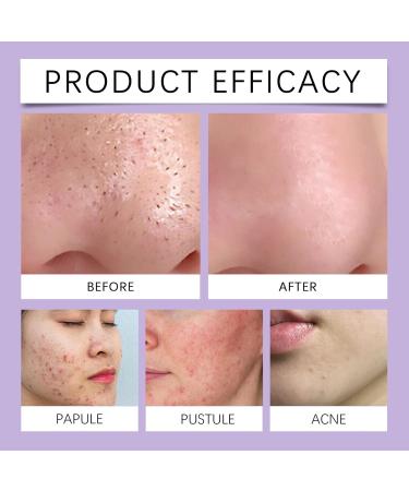  Generisch Blemish Gel Cream - 40g - Daily Soothing Care - Clarifying Gel - For daily use under makeup after cleansing at bedtime at home while traveling in the morning and... - Buy Online on GoSupps.com