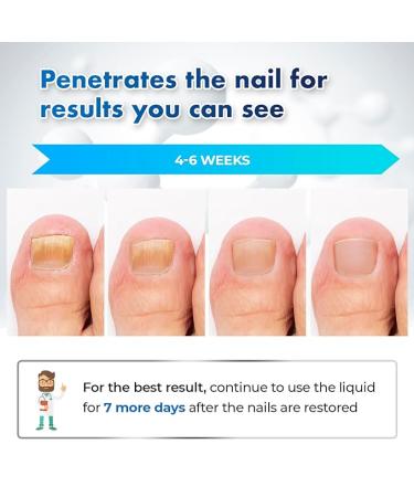 Toenail Fungus Treatment Extra Strength: Fungus Nail Treatment Fast Acting - Nail Fungal Treatment for Toenail and Fingernail - Nail Fungus Treatment for Men & Women - 30ML - Buy Online on GoSupps.com