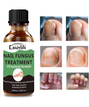 Nail Fungus Treatment for Toenail Extra Strong Nail Fungus Treatment for Toenail and Fingernail Anti fungus Nail Repair and Strengthen Fix & Renew Damaged Broken Nails (30ml) - Buy Online on GoSupps.com