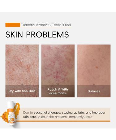  YOENBG West Month 3-Pack Hydrating Vitamin C Turmeric Face and Neck Toners - Buy Online on GoSupps.com