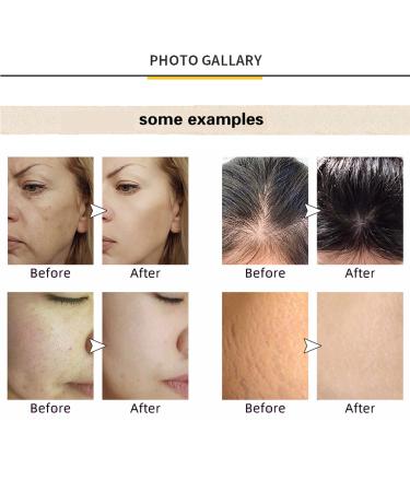 Koi Beauty Adjustable Derma Stamp Microneedling Pen for Face & Body - Professional Dermapen for Hair Growth - Men & Women Home Use - Buy Online on GoSupps.com