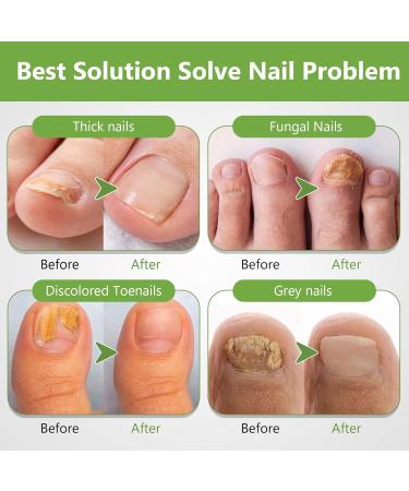  Sikeydels Foot Nail Care Nourish and Soothe Nails Strengthens Nail Structure Nail Treatments with 1 Nail File 30ml - Buy Online on GoSupps.com