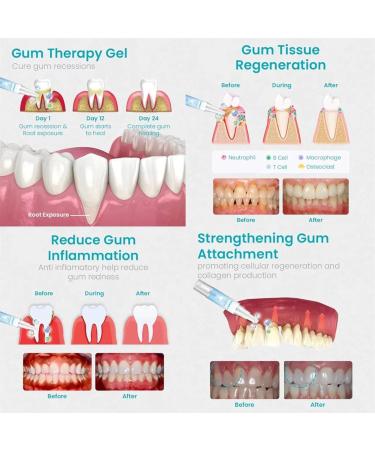 Neslemy Gum Gel NESLEMY Gum Shield Therapy Gel 2024 New Gum Repair Treatment Gel Dentizen Gum Therapy Gel Teeth Whitening Essence Pen Deeply Cleaning Gums Enhances Overall Gum Health (5Pcs) - Buy Online on GoSupps.com