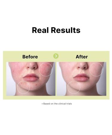 DearMYDEW 10% Azelaic Acid Serum with Niacinamide Salicylic Acid Allantoin Rosacea Treatment for Face Redness Relief Reduce Cystic Acne Scar Pimples Non-Comedogenic Korean Skincare 1Fl Oz - Buy Online on GoSupps.com