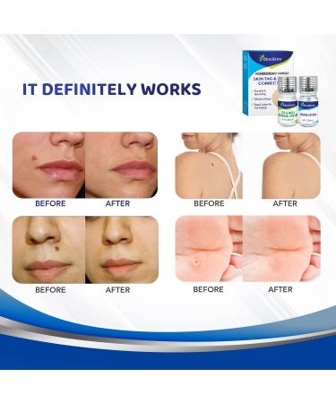 Mole Removal & Skin Tag Repair Gel Set - Remove Effectively at Home - Buy Online on GoSupps.com