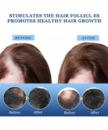 TUITUII Hair Growth Serum Hair Growth Serum Hair Lotion Hair Regrowth Lotion Hair Growth Care 20 g Hair Growth Serum Hair Growth Serum Hair Growth Serum Hair Growth Ointment - Buy Online on GoSupps.com