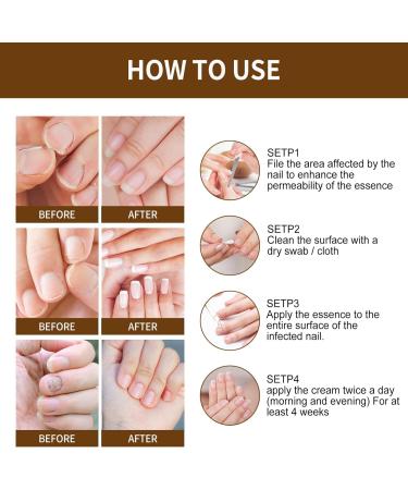 TBeautfave Fungal Nail Treatment Nail Fungus Treatment for Toenail Fungal Nail Treatment for Toenails Extra Strong Nail Strengthener for Damaged Nails Nail Repair Renew Broken Nails Nail Care - Buy Online on GoSupps.com