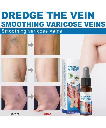 Spray de Traitement des Varices Spray apaisant pour Les Varices Kit Naturel d limination des Varices Am liorer la Circulation Sanguine pour Les Femmes et Les Hommes - Buy Online on GoSupps.com