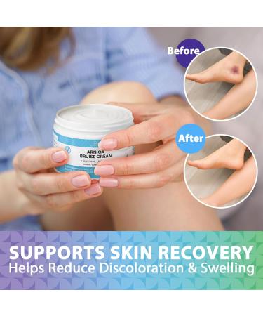 Arnica Bruise Cream Extra Strength: Rapid Relief for Bruising Swelling Soreness Pain on Thin Skin - Potent Arnica Montana with Vitamin K Coconut Shea Butter - Face & Body 120g - Buy Online on GoSupps.com