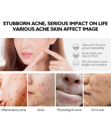 Rosarden Anti Acne Serum for Face Natural Herbal Face Serum for Improvement Pimples Pore Acne Scar Anti Pimple Serum Face Care for All Skin Types of Acne - Buy Online on GoSupps.com