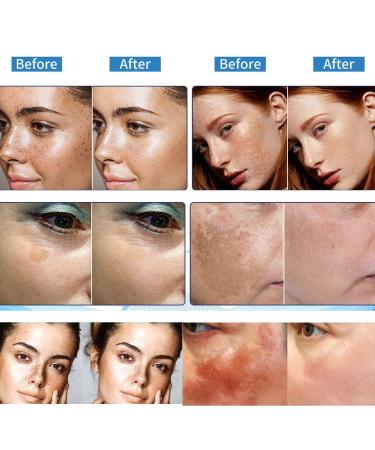 Dark Spot Remover for Face | Hyperpigmentation & Melasma Treatment | Corrector for All Skin Types - Buy Online on GoSupps.com