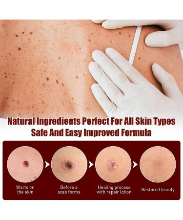 WZDYN 2023 New Wipe Off and Remover | Extreme Skin Wipe Off & Remover | Fast Easy to Remove | for Face Armpit Flesh Neck (5pcs) - Buy Online on GoSupps.com