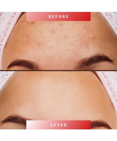 12% Azelaic Acid Cream with Pimple Popper Tool - Advanced Blemish Control & Redness Relief for Sensitive Skin - 1 fl oz / 30 ml - Buy Online on GoSupps.com