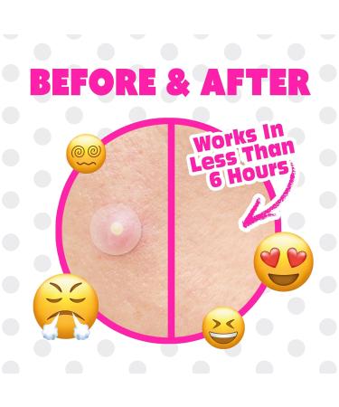 Pimple Patches for Face Original- Hydrocolloid Acne Patches for Blemishes & Breakouts and Absorbing Zits Recover the Spot Quickly Cover Spot from Dirt Invisible Finished - Buy Online on GoSupps.com