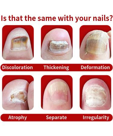 Nail Onychomycosis Rapid Relief Oil - Onychomycosis Rapid Relief Oil Onychomycosis Nail Treatment Oil Quick Relief Oil Toenail Repair for Damaged Nails(10ml) - Buy Online on GoSupps.com