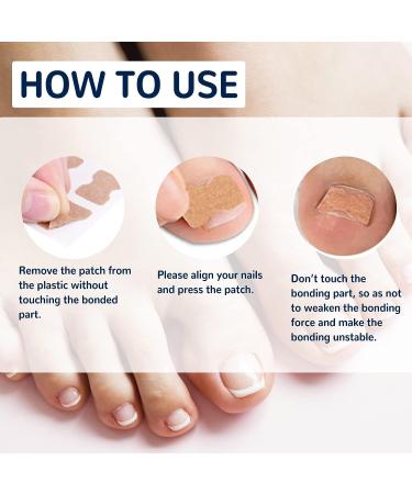 100PCS Ingrown Toe Nail Correction Sticker - Health Toenail Corrector Patch - Buy Online on GoSupps.com
