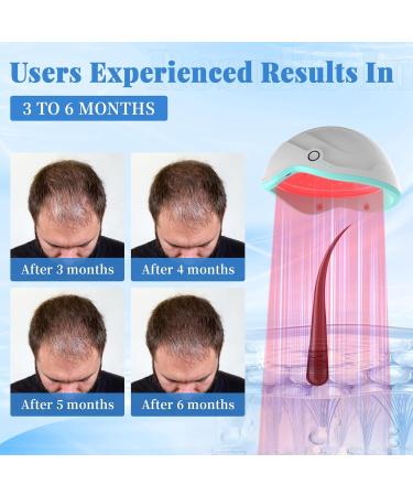 Laser Hair Growth Cap Red Light Therapy Helmet for Hair Regrowth FDA Cleared Hair Loss Treatment for Men and Women with Thinning Hair Rechargeable Hair Growth Product - Buy Online on GoSupps.com