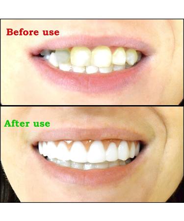 Realistic Upper and Lower Veneer Cosmetic Teeth Set for Confident Smile - 4 PCS Fake Teeth for Men and Women with Comfortable Fit - Buy Online on GoSupps.com