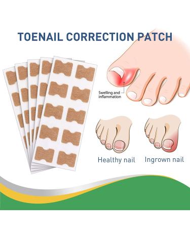 Fitmedify Ingrown Toenail Corrector Kit - Nail Patches for Ingrown Toenail Treatment and Removal - Buy Online on GoSupps.com