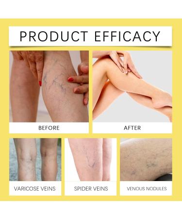  ALLILUYAA Zoencgz Pack of 2 Bee Poison Creams - Bee Venom and Varicose Veins - Buy Online on GoSupps.com