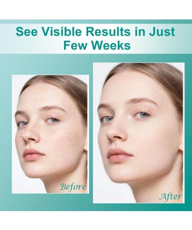 Dark Spot Remover for Face & Body, Dark Spot Corrector- Age Spot Sun Spot Freckles Melasma Brown Spot Remover Skin Care Repair Cream for All Skin Types1.7 FLOZ 1.7 Fl Oz (Pack of 1) - Buy Online on GoSupps.com