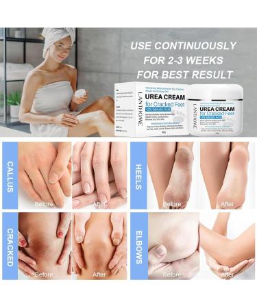 Urea 40% Foot Cream Cracked Heel Repair Cream Callus Remover For Dry And Hard Skin Feet and Hand Urea Lotion for Feet Maximum Strength Foot and Body Care - Buy Online on GoSupps.com