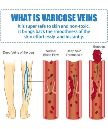 Venoheal Varicose Vein Treatment Cream Relie Vein Treatment Cream Anti-Varicose Vein Treatment for Legs Varicose Vein Care Cream Vein Care Cream for Legs Pen & Cream - Buy Online on GoSupps.com