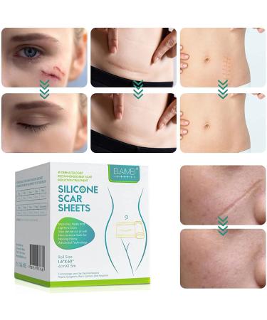Silicone Scar Sheets - Medical Grade Removal Patches for C-Section, Surgery, Burn, Keloid, Acne - 1.6 x 60 - 1.5M - Buy Online on GoSupps.com