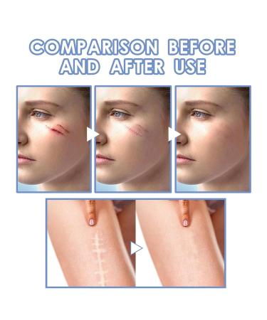 Ampoule Scar Removal Serum - Advanced Medical Grade Scar Repair for All Types of Scars (2BOX) - Buy Online on GoSupps.com