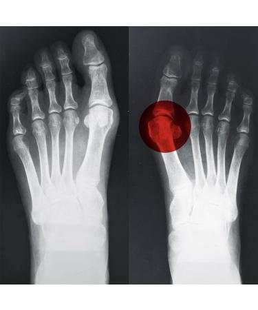 Hallufix Bunion Protector and Correction Splint | for Men and Women | Hallux Valgus Bunion Corrector | Helps straighten The Big Toe and Provide Bunion Relief of Pain | Premium Device Made in Germany UK: 3 -7 - EU: 36-42 - Buy Online on GoSupps.com