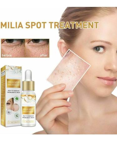 ZHBiwmatn 2024 New 4Pcs Milia Clearing Essence Milia Remover Eye Serum Milia Remover Milia Spot Treatment Miliary Repair Essence Moisturize Skin Improve Skin Texture for All Skin Types 30ml/1.8fl.oz - Buy Online on GoSupps.com