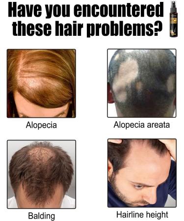 Ginger Germinal Oil Ginger Hair Growth Serum Ginger Essential Oil Stop Hair Loss Hair Thinning Treatment Hair Growth Oil for Women & Men 30ML (1pcs) - Buy Online on GoSupps.com