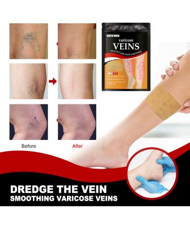Xiyinli 12-Part Varicose Vein Health Paste - Skin-Friendly & Non-Toxic Relief for Swelling and Pain - Buy Online on GoSupps.com