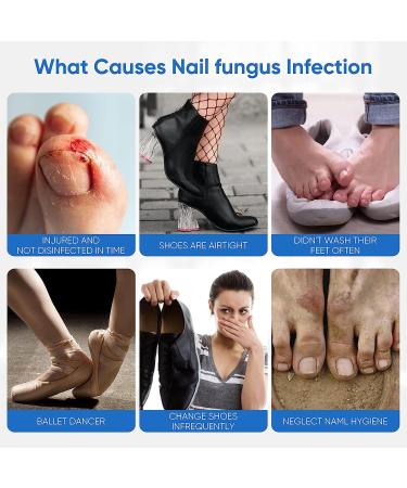 32Pcs Nail Repair Patches - Toenail Fungus Treatment for Damaged Nails - Buy Online on GoSupps.com
