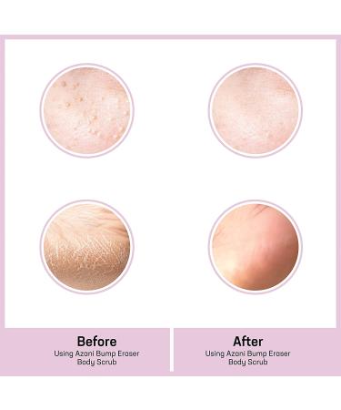Azani Bump Eraser Body Scrub | 5% Glycolic & Lactic Acid Exfoliator | For Keratosis Pilaris, Body Acne, Ingrown Hair & Razor Bumps | Smooths Rough Patches on Knees, Arms & Neck | 3.5 Oz - Buy Online on GoSupps.com