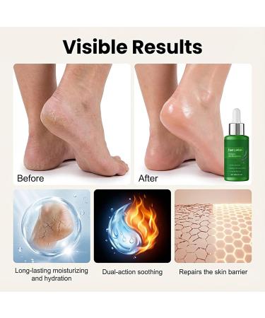  Holdes Foot Cream 30ml Moisturizing Heel Balm | Intensive Foot Moisturizer Daily After-Shower Care for Dry Winter Climates and Travel - Buy Online on GoSupps.com