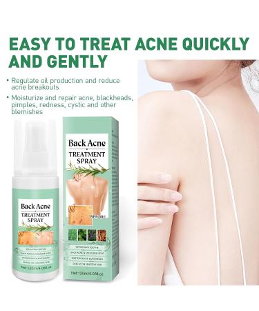 Back Acne Treatment Spray With Herbal Formula 2% Salicylic Acid & Tea Tree Oil - Body Acne Solution 120ml 1PCS - Buy Online on GoSupps.com