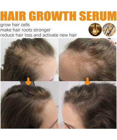 KiJalyelu Biotin Fast-growing Hair Essential Oil for Hair Loss Biotin Roll-On Oil for Thin Hair Hydrating & Nourishing Anti Hair Growth Serum Fuller and Faster Growing Hair - 30ml (3PC) - Buy Online on GoSupps.com