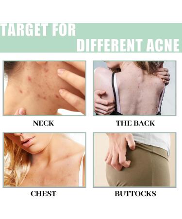 Acne Treatment Spary Back Acne Body Wash Aloe Soap for Face & Body Acne Marks Skin Care Spray Body Moisturiser For Acne Shoulder &Back Acne Reduce Back Acne& Nourishing-(Anti Acne Spray+Aloe Soap) - Buy Online on GoSupps.com