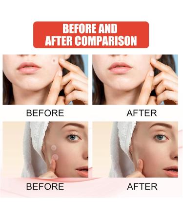 Original Hydrocolloid Acne Patches - 108 Count Spot Stickers for Zits & Blemishes | International Shipping - Buy Online on GoSupps.com