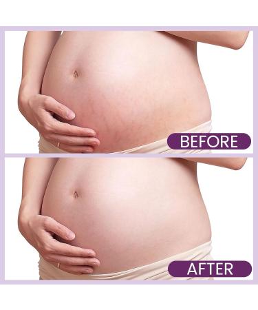 AOAO Stretch Mark Butter for Pregnancy | Body Balm for Women with Shea Butter & Vitamin E | Paraben-Free Formula for Scars & Stretch Mark Repair | Belly Butter for Pregnant Women (Shea Butter_1) - Buy Online on GoSupps.com