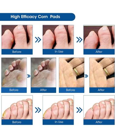 Corn Remover Pads - 42 Pcs Wart & Foot Corn Removal Patches for Pain Relief and Care - Buy Online on GoSupps.com