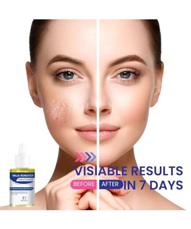 Milia Remover 30 ML - Dissolves and Reduces Milia  Whiteheads  and Sebaceous Hyperplasia - Buy Online on GoSupps.com
