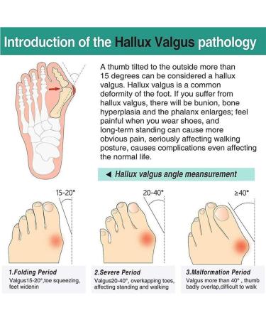 LGZY Big Toe Bone Correction Sandals | Arch Support Orthopedic Shoes for Women | Non-Slip Beach Slippers | Hallux Valgus Bunion Relief | Khaki Size 41 - Buy Online on GoSupps.com