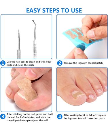 SANNIX Ingrown Toenail Tool Set with 100 Pieces Correction Patches Curved Double Toenail File & Ingrown Nail Cleaner for Men and Women - Buy Online on GoSupps.com