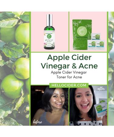 Organic Apple Cider Vinegar Acne Face Wipes | Tea Tree Rose Chamomile Witch Hazel | 25ct for All Skin Types | USA Hello Cider - Buy Online on GoSupps.com