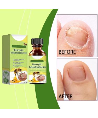 Furzero Bee Venom Nail Serum Furzero Nail Defence Bee Venom Treatment Serum Pro Bee Venom Nail Treatment Serum Bee Venom Nail Treatment Serum (2 Pieces) - Buy Online on GoSupps.com