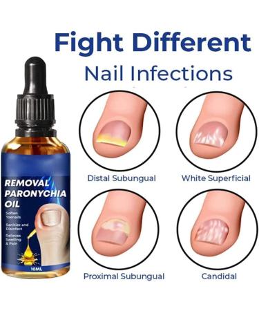 Huile de paronychia allemande pour enlever la paronychia traitement des ongles des pieds meilleure solution de r paration des ongles liquide de renouvellement des ongles endommag s (3 pi ces) 3 pi ces. - Buy Online on GoSupps.com